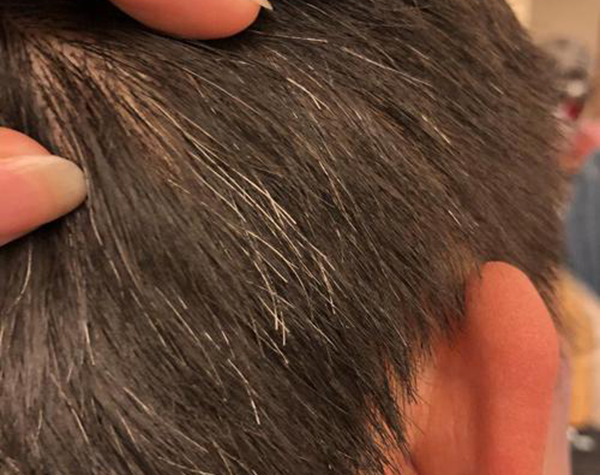 什么是營(yíng)養(yǎng)性灰白發(fā)？