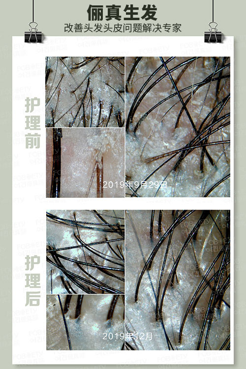 頭油、頭癢